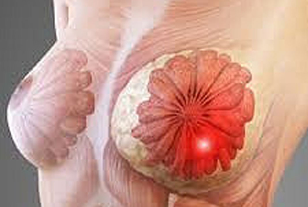 Các bệnh về vú và mối liên hệ với ung thư vú. 39818908013 38a287c287 M