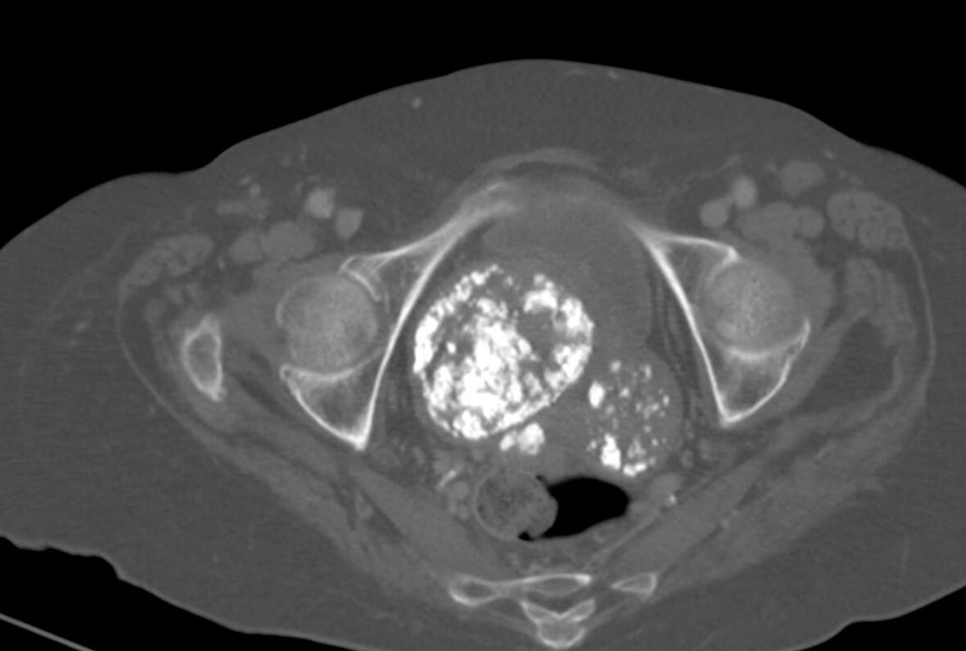 Điều trị u xơ vú Aced39be682d609c4af9b64b8d8cad