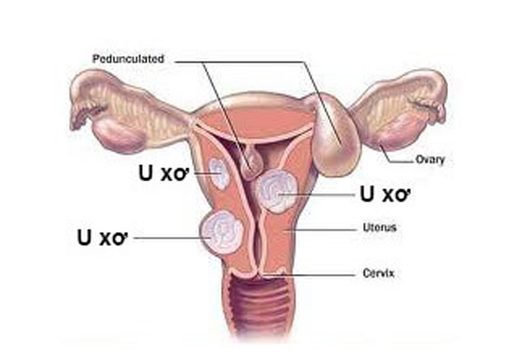 Đột nhiên khiến tiêu tan U xơ Vú, U xơ Tử Cung trở nên dễ dàng