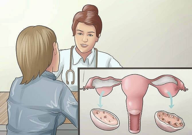 U nang buồng trứng kích thước bao nhiêu thì mổ? U Nang Buong Trung Kich Thuoc Bao Nhieu Thi Mo 1